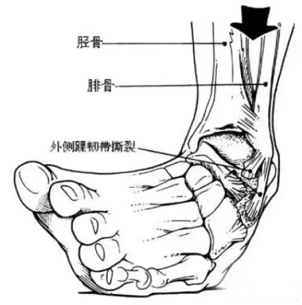 足踝部肌腱解剖图图片